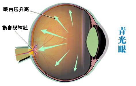 為什么眼壓升高可能會(huì)致盲?